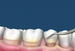 洗牙视频全过程,从准备到结束的全方位体验